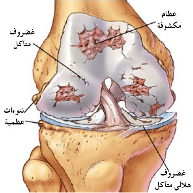 علاج غضروف الركبة بالاعشاب , وداعا للغضاريف بالطرق الطبيعية