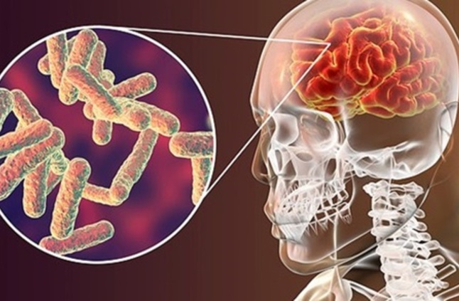 اعراض التهاب السحايا - خطر الاصابة بالالتهاب السحائي 2564 2