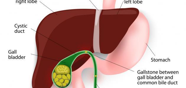 علاج تضخم الكبد - امراض تصيب الكبد 5595 3