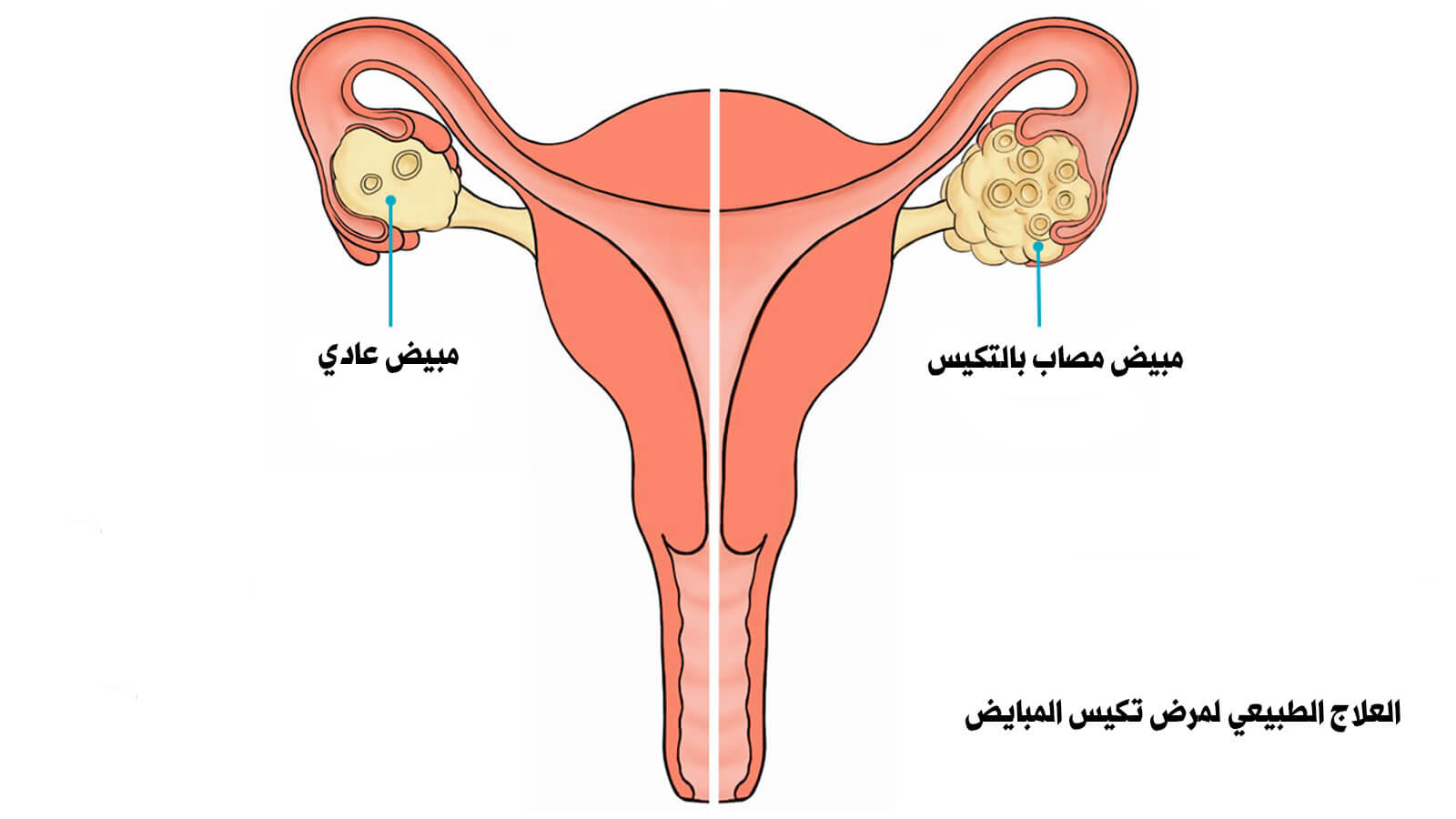 علاج ضعف التبويض عند المراة , تعرفي علي الاسباب وطرق العلاج