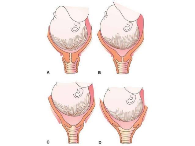 كيف اخلي راس الجنين ينزل في الحوض , فوائد ودلائل نزول راس الجنين في الحوض