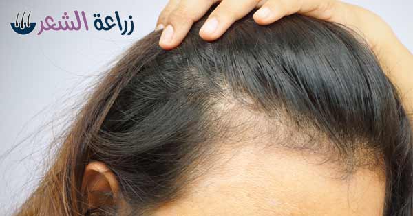 تجارب زراعة الشعر في تركيا - ازرع شعرك و تخلص من الصلع 5671 4