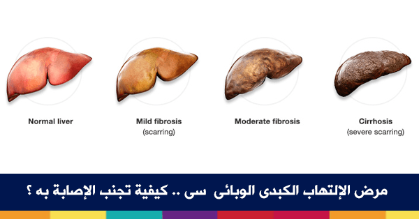 الكبد الوبائي كيف ينتقل , أنواع الفيروس