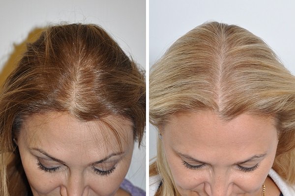 تجارب زراعة الشعر في تركيا - ازرع شعرك و تخلص من الصلع 5671 12