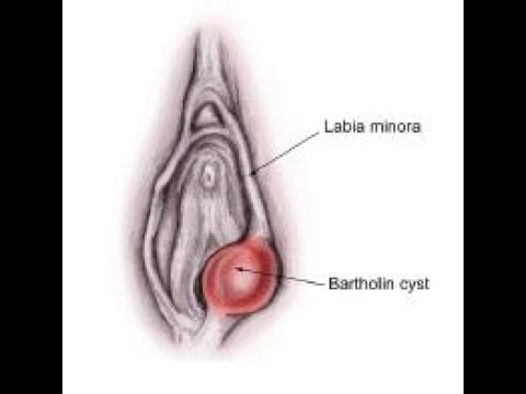 علاج غدة بارثولين , حلول بسيطة لمشكلة غدة بارثولين لدي النساء