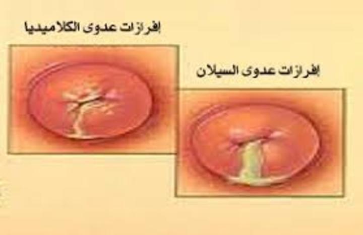 الامراض الجلدية التناسلية عند الرجال بالصور , خطر العدوى بالامراض التناسلية