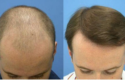 تجارب زراعة الشعر في تركيا - ازرع شعرك و تخلص من الصلع 5671 7