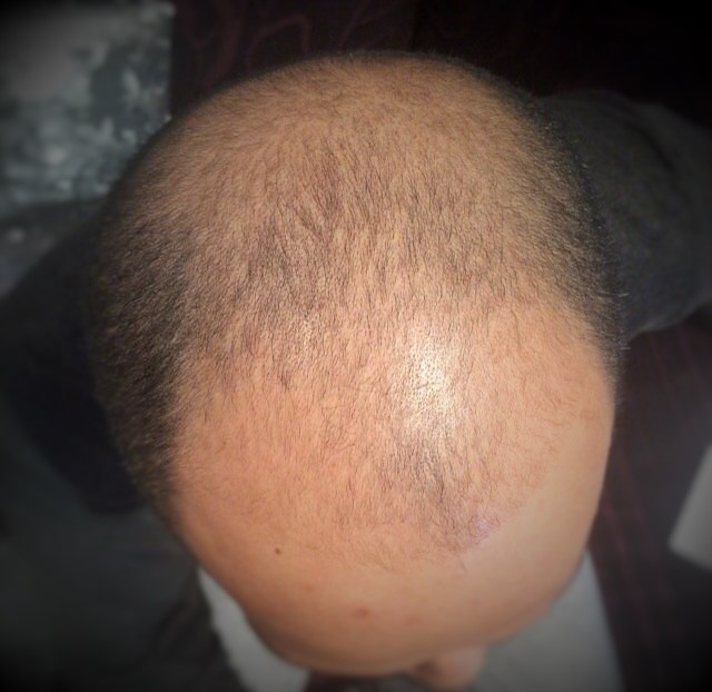 تجارب زراعة الشعر في تركيا - ازرع شعرك و تخلص من الصلع 5671 3