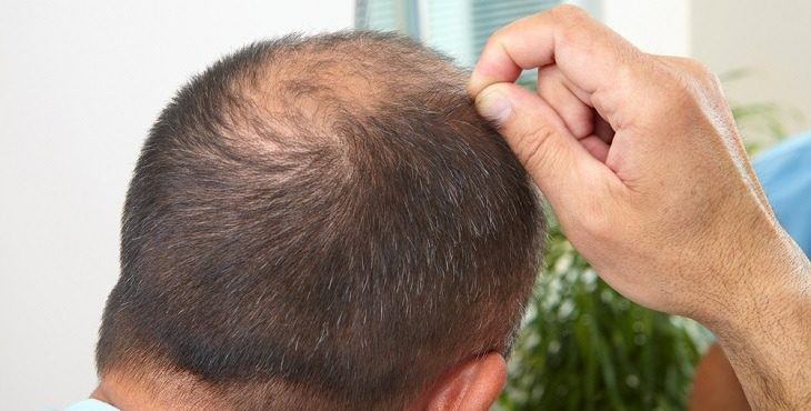 تجارب زراعة الشعر في تركيا - ازرع شعرك و تخلص من الصلع 5671 2