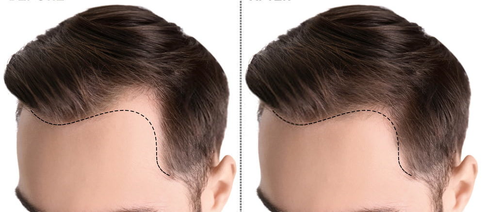 تجارب زراعة الشعر في تركيا - ازرع شعرك و تخلص من الصلع 5671 9