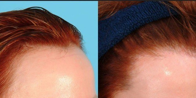 تجارب زراعة الشعر في تركيا - ازرع شعرك و تخلص من الصلع 5671 8