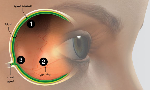 علاج عصب العين - اسباب مرض عصب العين 3046 2