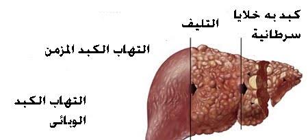 اعراض فيروس الكبد سي , اعراض مرض فيرس سي